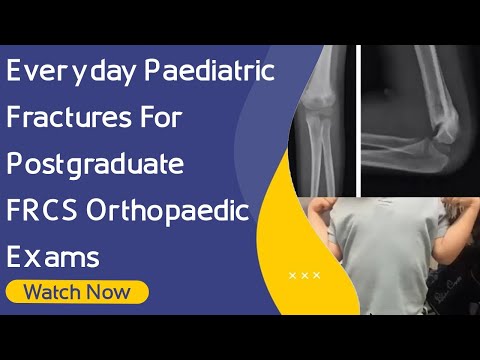 Everyday Paediatric Fractures For Postgraduate Orthopaedic Exams