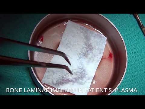 perioimplant regeneration -bone laminae