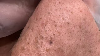 Skin Savvy: Blackhead Removal / With Extractions & Extended Skincare Routine (Full Process)