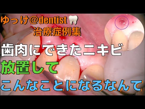 生命歯学科 【閲覧注意】歯肉のニキビ放っておかないで！　抜歯と診断された歯を抜かずに残すマイクロスコープを用いた歯根端切除術