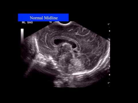 image-What is Neurosonography?