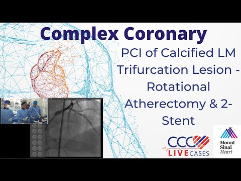 PCI of Calcified LM Trifurcation Lesion - Rotational Atherectomy & 2-Stent - CCC Live May 2017