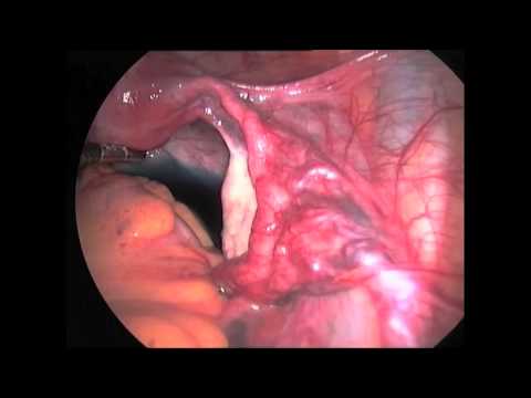 Canulation hystéroscopique pour obstruction tubaire proximale