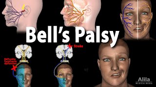 Bell&#39;s Palsy, Pathophysiology, Symptoms, Diagnosis and Treatment, Animation