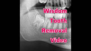 Wisdom Tooth Removal Step by Step