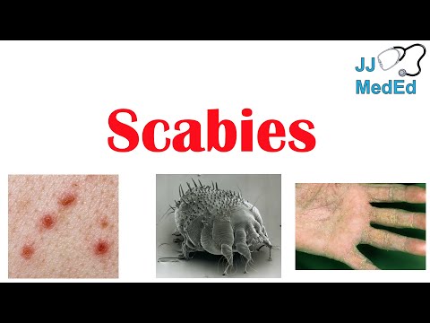 , title : 'Scabies (Skin Condition) | What Is It, Classic vs. Crusted Types, Signs & Symptoms, Treatment'