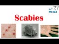 Scabies (Skin Condition) | What Is It, Classic vs. Crusted Types, Signs & Symptoms, Treatment