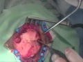 Chirurgie du cerveau(opération d'une tumeur au ...