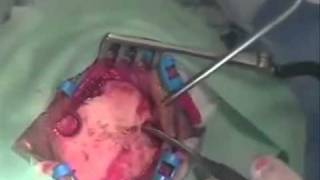 Chirurgie du cerveau(opération d'une tumeur au cerveau)