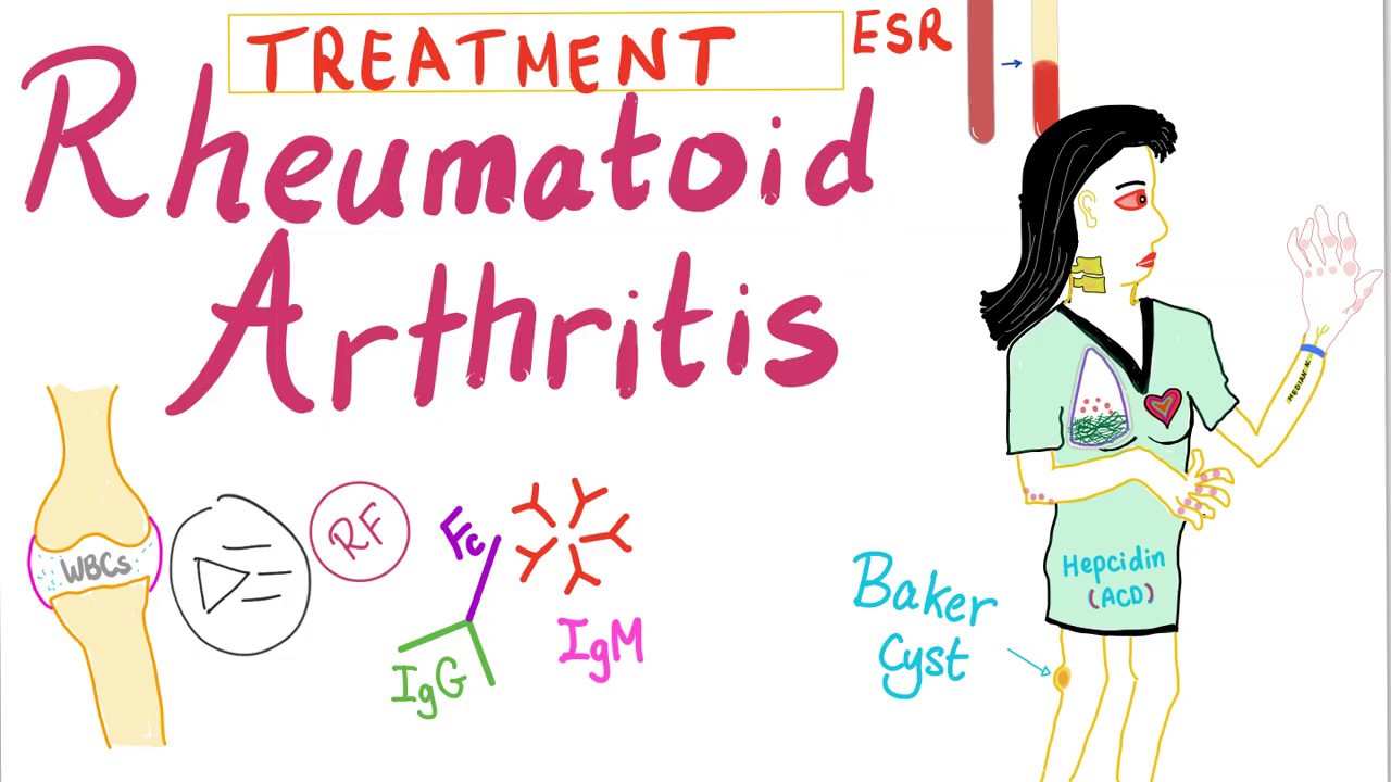 Rheumatoid Arthritis (Part 10): Management, Introduction