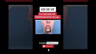 ASÍ SE VE LA FEMINIZACIÓN FACIAL #SaludTrans