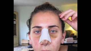 VLog of my Rhinoplasty Surgery, Recovery, #6