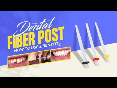 Demystifying Fiber Posts:Secure Foundations for strengthening Smiles #dentalkart #FiberPostBenefits