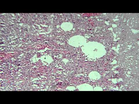 04 Langerhans Giant Cell within a granuloma