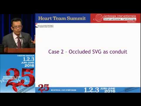 08 - Review the antegrade versus retrograde approaches for the treatment of CTO - Minh Vo