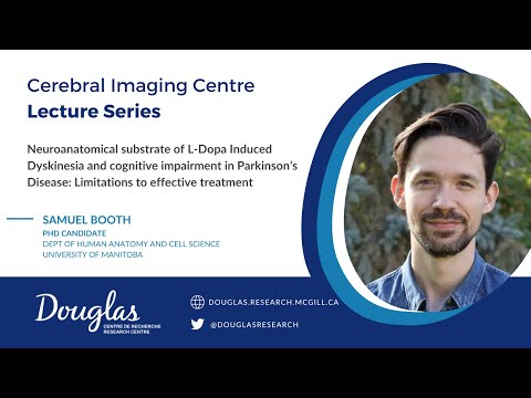 L-Dopa Induced Dyskinesia and cognitive impairment in Parkinson's Disease