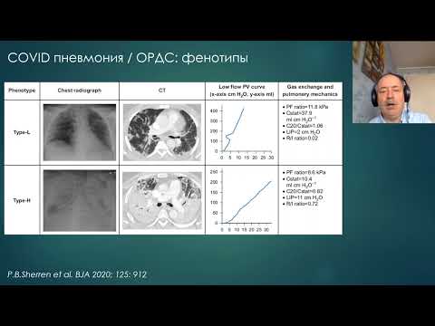ИВЛ при SARS CoV-2 (CARDS) Сатишур О.Е.