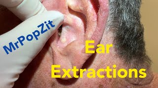 Ear blackhead extractions. Deep filled pockets in the ear concha expressed out.