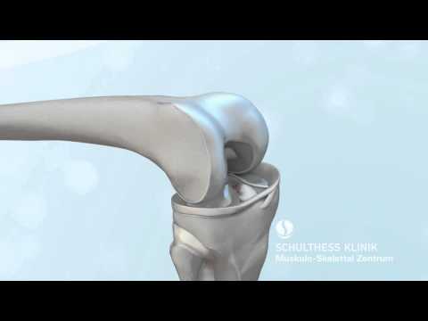 Dass Verletzungen auf der linken Seite auf der Rückseite unterhalb der Rippen Behandlung von Osteoarthritis und Osteoporose Volksmedizin