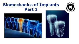 Biomechanics of dental implants Part 1