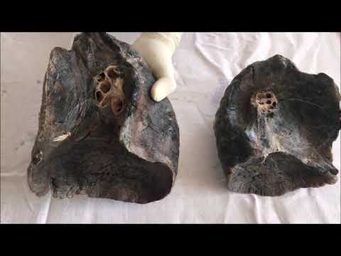 Lungs Anatomy Part 1