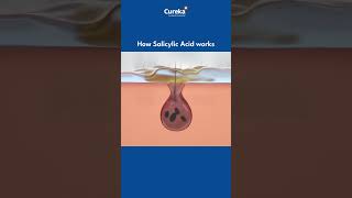 Download lagu How does Salicylic Acid work? mp3 Download lagu How does Salicylic Acid work? mp3