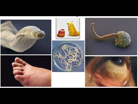 A paraziták típusai az emberi test kezelésében