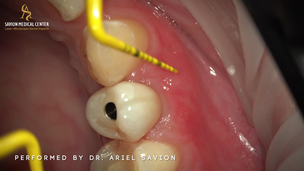 TOOTH EXTRACTION AND IMMEDIATE IMPLANT PLACEMENT IN ESTHETIC ZONE BY DR. ARIEL SAVION