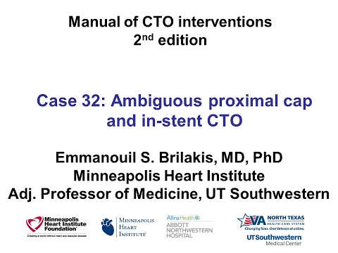 Case 32: Manual of CTO Interventions - Scratch and go and stent crush for in-stent CTO