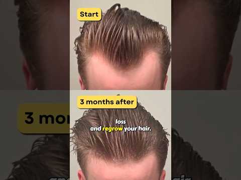 Best 5 Hair Loss Treatments (Ranked!)