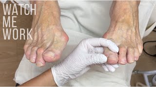 Gentle, professional care for mature feet, thickened toenails and dry skin vs. callus