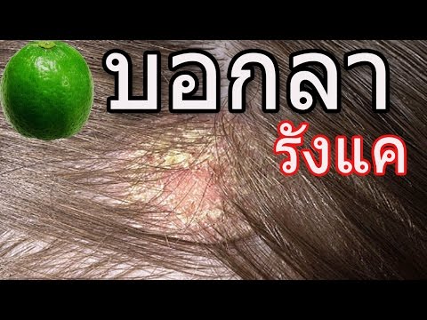 ครีม emolium สำหรับโรคสะเก็ดเงิน ที่ผมสูญเสียถ้าโรคสะเก็ดเงิน