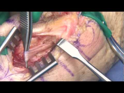 Ulnar Collateral Ligament Reconstruction - Modified Docking Technique