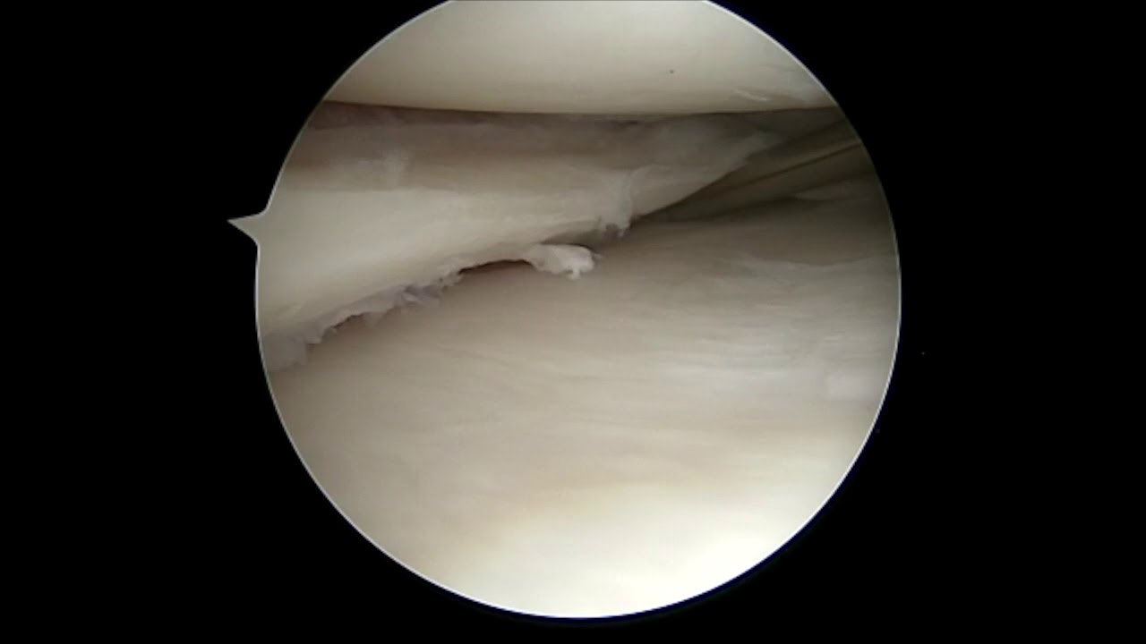 Dr. Garcia demonstrates his inside-out meniscus repair technique for complex tears.