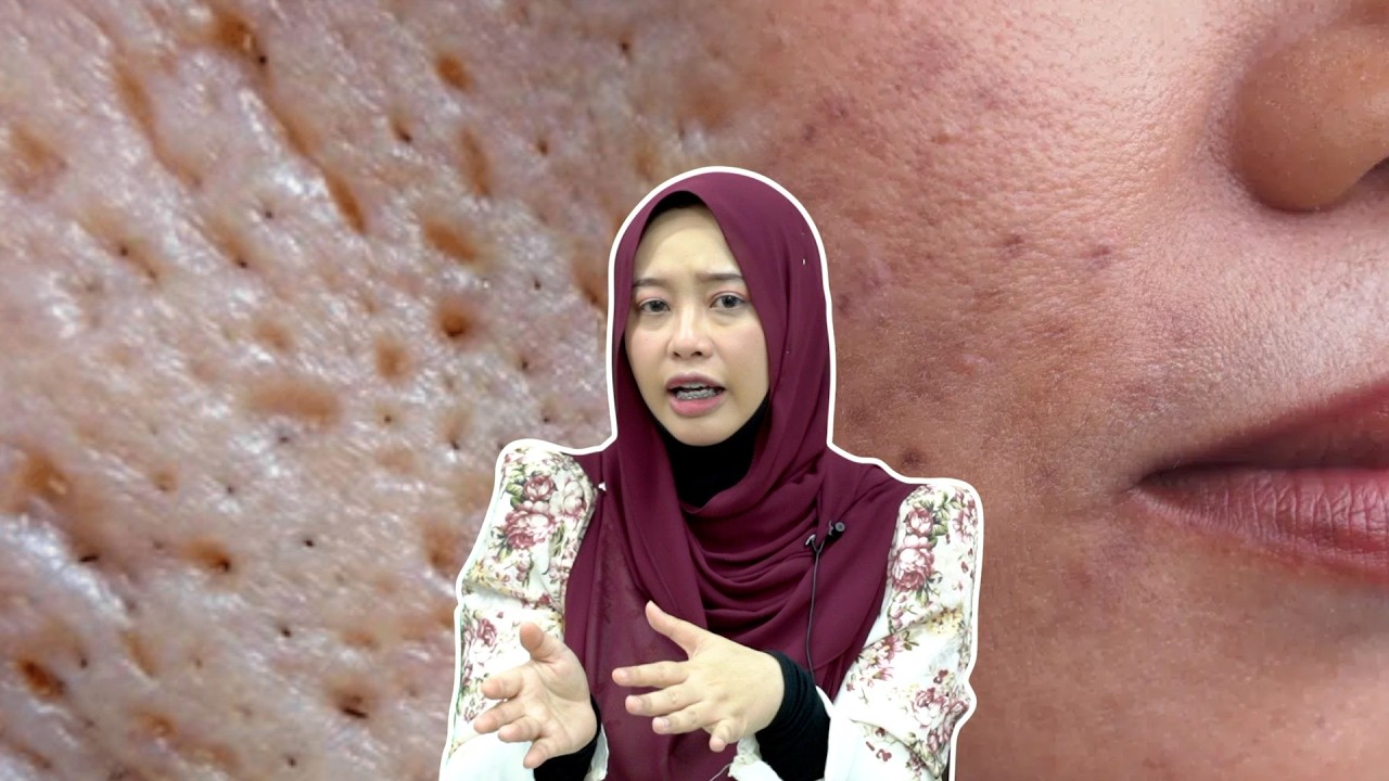 Parut Jerawat Boleh Hilang Ke Pakai Serum?