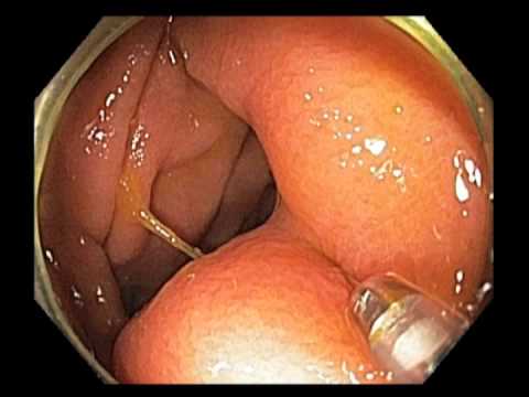 Ileocecal Valve - Subtle Lesion