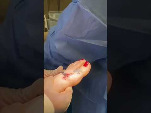 Cosmetic Toe Shortening Long Toe Surgery Video Without Metal Pins