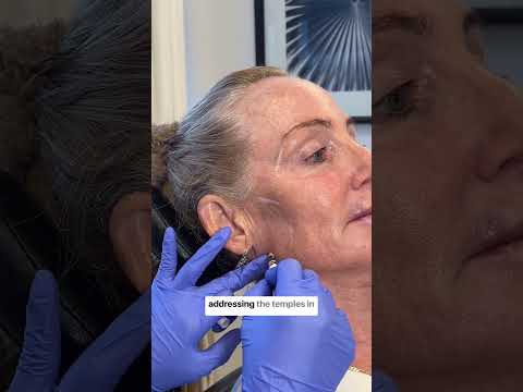 How cheek filler can age you!