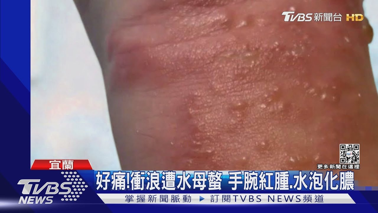 好痛！衝浪遭水母螫　手腕紅腫、水泡化膿