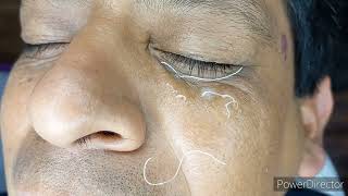 FUNCIONA! HILOS TENSORES DE COLAGENO REABSORVIBLES ARRUGAS LIFTING