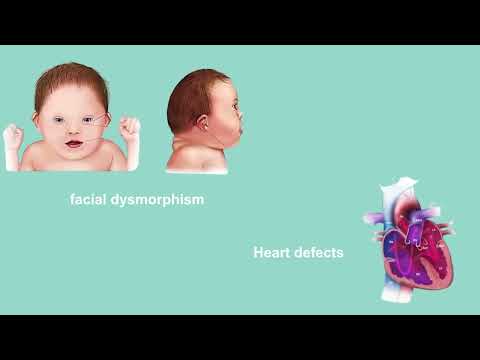 Trisomy 21 Explained: The Science Behind Down Syndrome in 60 Seconds!