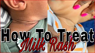 How To Treat Baby Neck Rash Fast | Drool Rash | Milk Rash | @AquaphorUS @desitinme8672