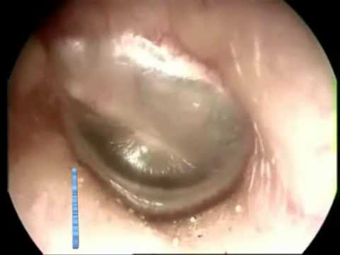Cura di eczema su mani del periodo di una lattazione Enterozhermina a dermatite atopic