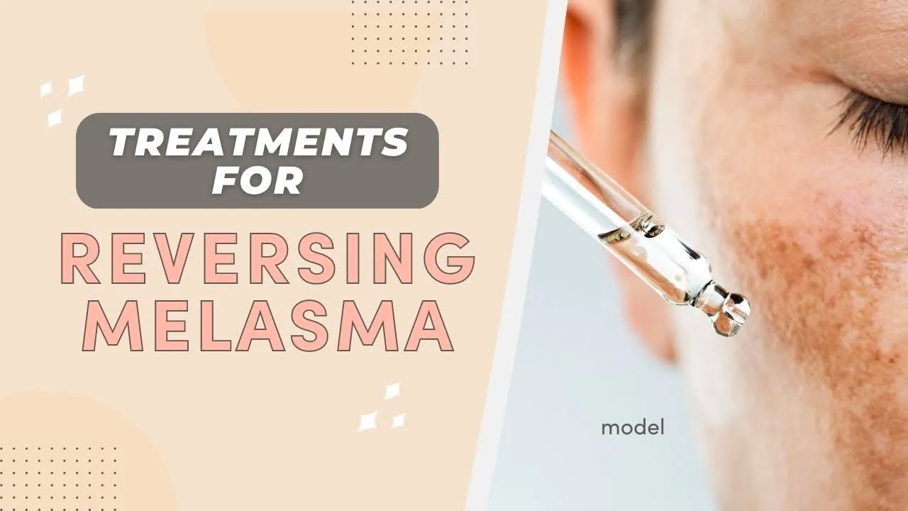 3 Treatments for Reversing Melasma that ACTUALLY work