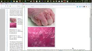 Morgellons disease! Its real!  Not delusional at all.  So why are wikipedia editors hiding evidence?