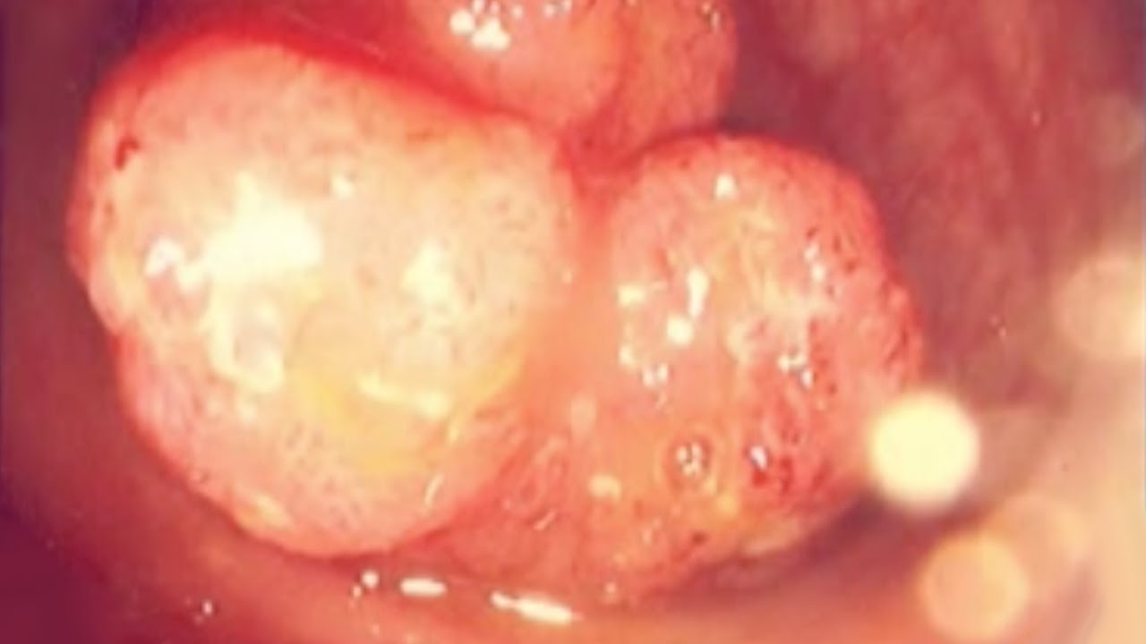 Colorectal Polyps - the various types and their management