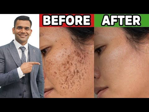 Magical Home Remedy To Treat Melasma, Dark Spot and Pigmentation