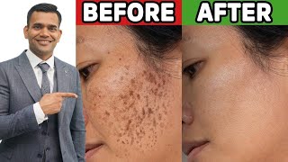 Magical Home Remedy To Treat Melasma, Dark Spot and Pigmentation