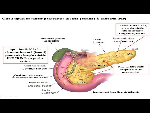 Viziune pancreatică. Cancerul pancreasului — IMSP SCM 