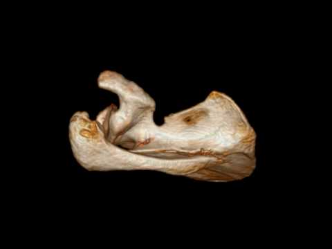 Scapular Spine Fracture